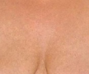 Chest Wrinkles - After Treatment