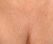 Chest Wrinkles - Before Treatment