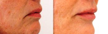 Downturned Mouth Lip Enhancement - Before and After