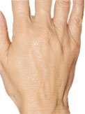 Hands After Radiesse Treatment