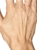 Hands Before Radiesse Treatment