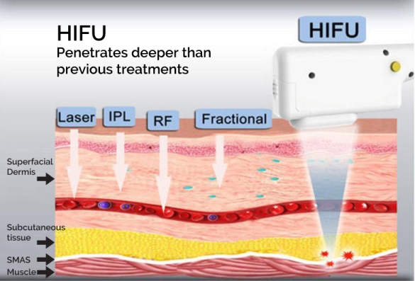 HIFU ultherapy