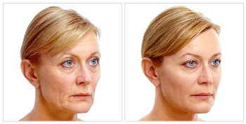 Juvederm Dermal Filler - Before and AfterTreatment