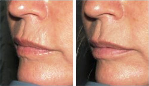 Mouth Lip Fillers - Before and After Picture