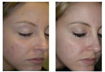 Before and After Glycolic Chemical Peel Treatment