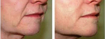 Nose to Mouth Lines - Before and After
