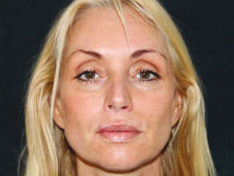 Radiesse dermal filler - After Photo