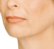 Radiesse dermal filler - Jawline After Photo