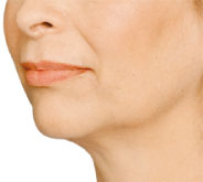 Radiesse dermal filler - Jawline Before Photo