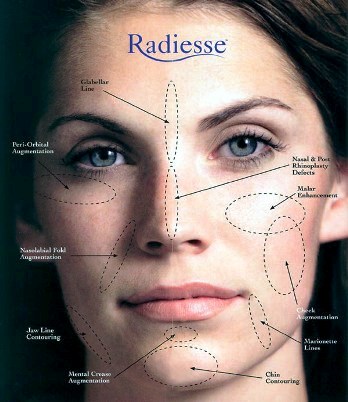 Radiesse Dermal Fillers -- Treatment Areas