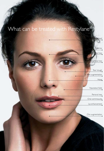 Restylane Dermal Fillers -- Treatment Areas