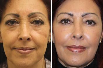 Sculptra dermal filler - Before & After Treatment