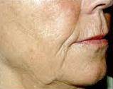 Sculptra Before dermal filler Treatment