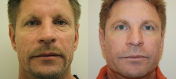 Dermal Filler Treatment for Men