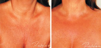 Skinboosters - Décolletage Before and After Treatment