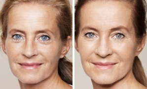 Skinboosters - Face Before and After Treatment