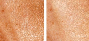 Skinboosters - Hand Before and After Treatment