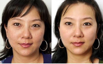 Before and After The Perfect Peel Treatment