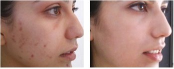 Before and After Chemical Peel Treatment