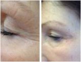 Thread Lift Treatment - Before and After - Eye Lift