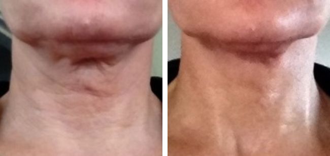 pdo thread lift neck before and after